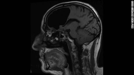 An MRI shows the air-filled cavity in the patient&#39;s brain.