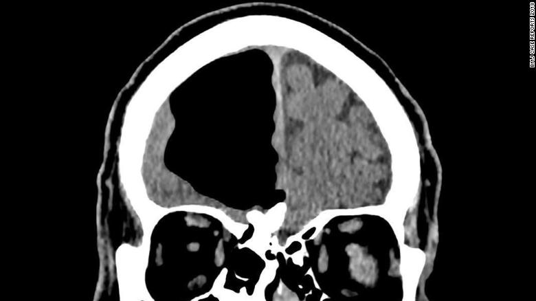 180313162714-01-air-pocket-brain-frontal-lobe-exlarge-169.jpg