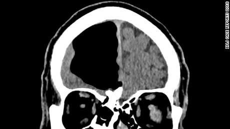 CT showing osteoma in paranasal sinus causing defect resulting in right pneumatocoele.