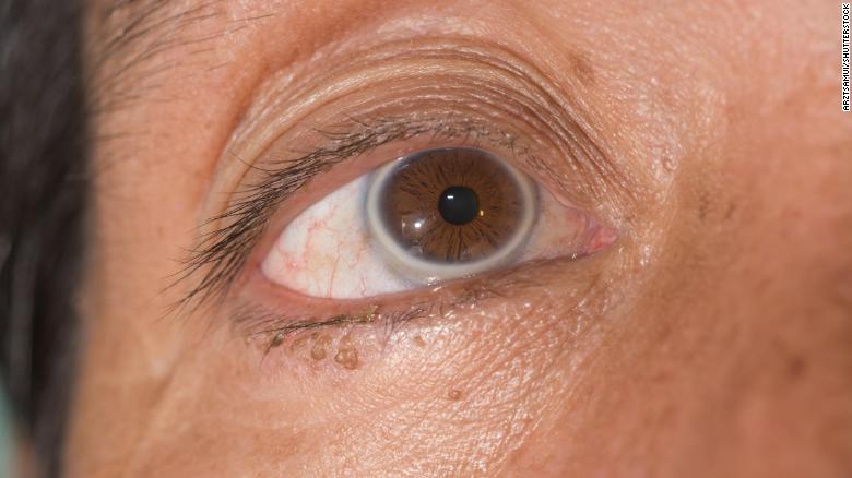 greys disease bulging eyeballs