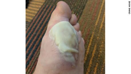 "I haven't seen my feet this bad since my days in the Army" two decades ago, teacher Craig Hoxie said. 