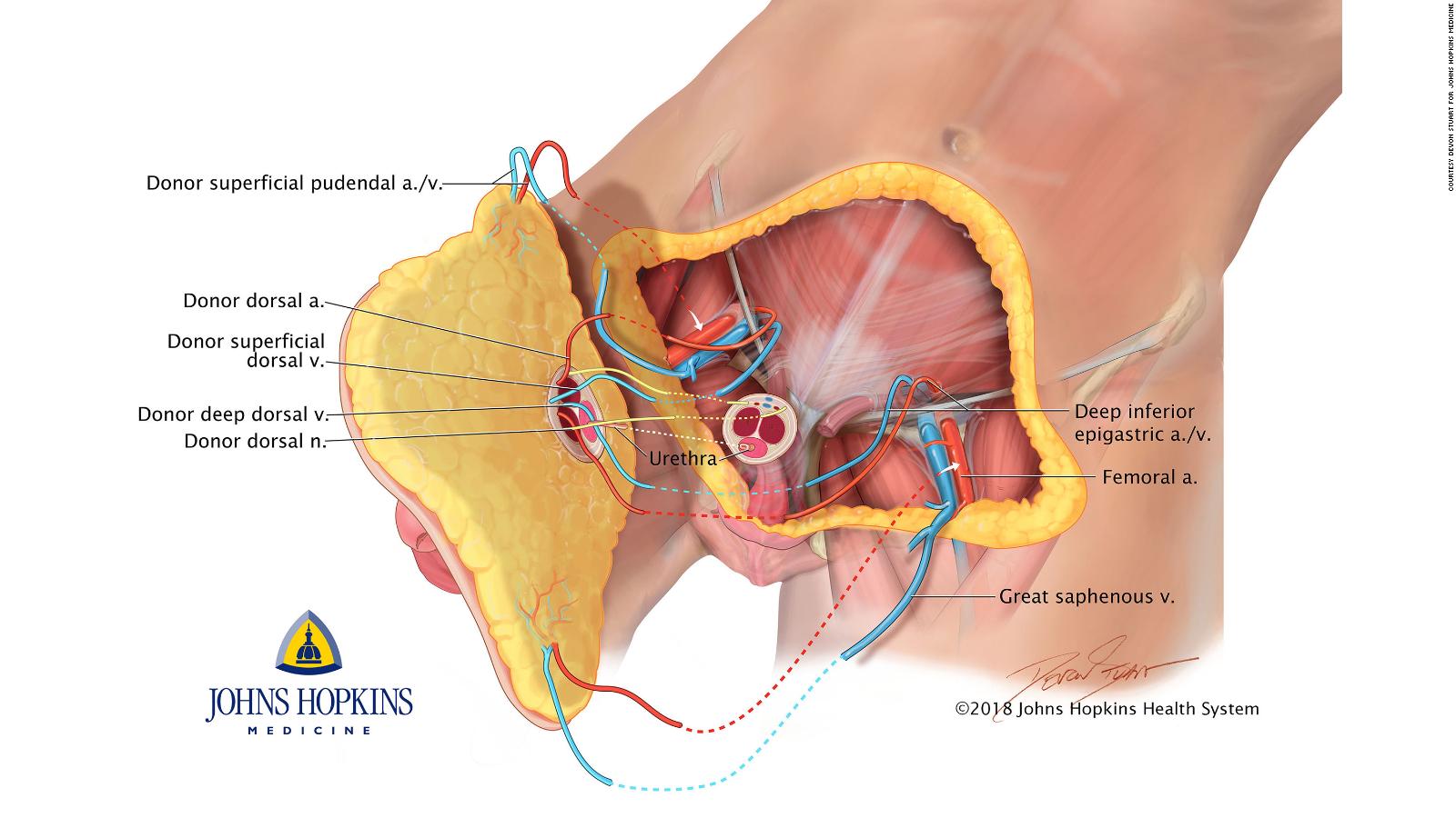 Wounded Veteran Receives First Penis And Scrotum Transplant Cnn