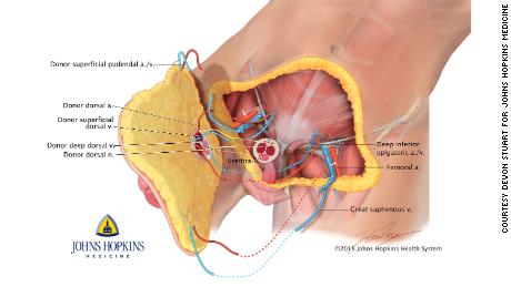 An illustration of how the transplant was performed.