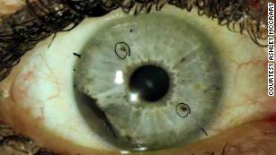 Bungee cord to the eye causes man's iris to collapse
