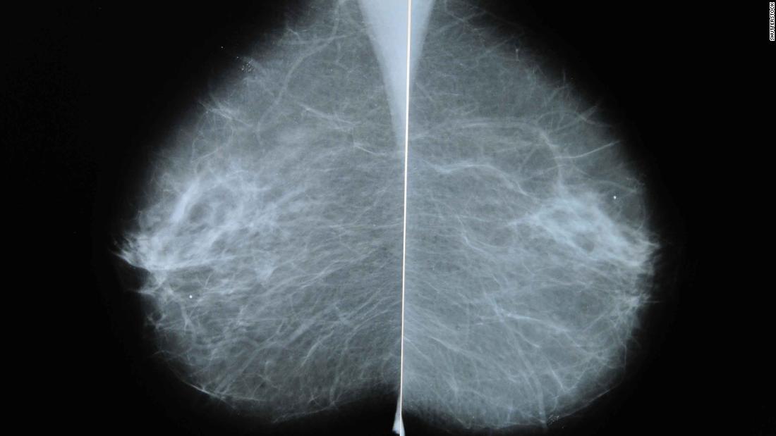 Mammograms show swelling related to the Covid-19 vaccine, the study says