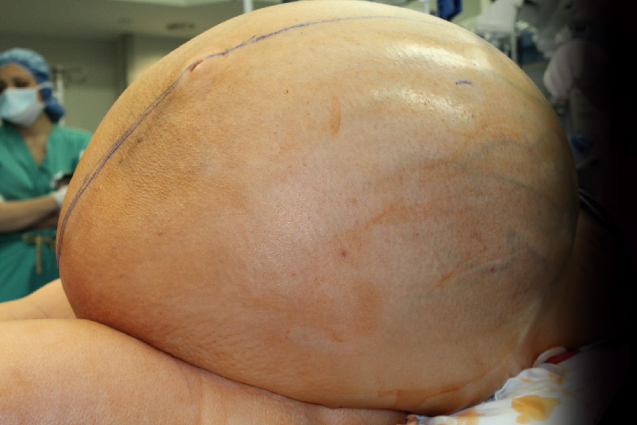 180503164342-01-ovarian-tumor-132-pounds.jpg