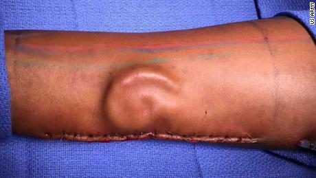 A soldier lost her ear in a car accident. So the doctors grew her a new one -- in her forearm