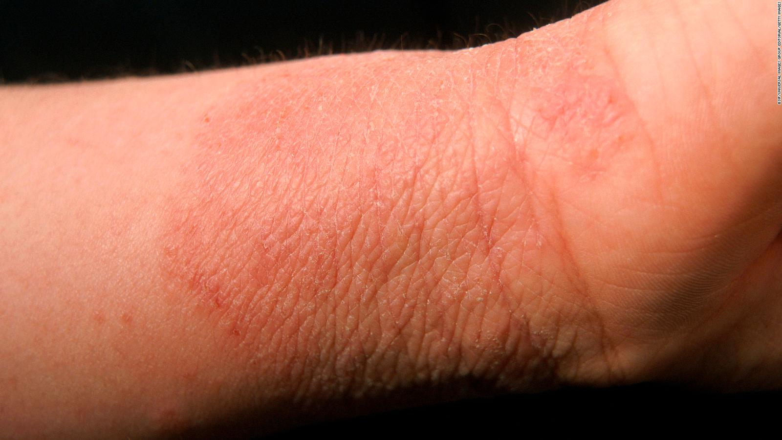 People With Eczema At Higher Risk Of Suicidal Thoughts And Attempts 