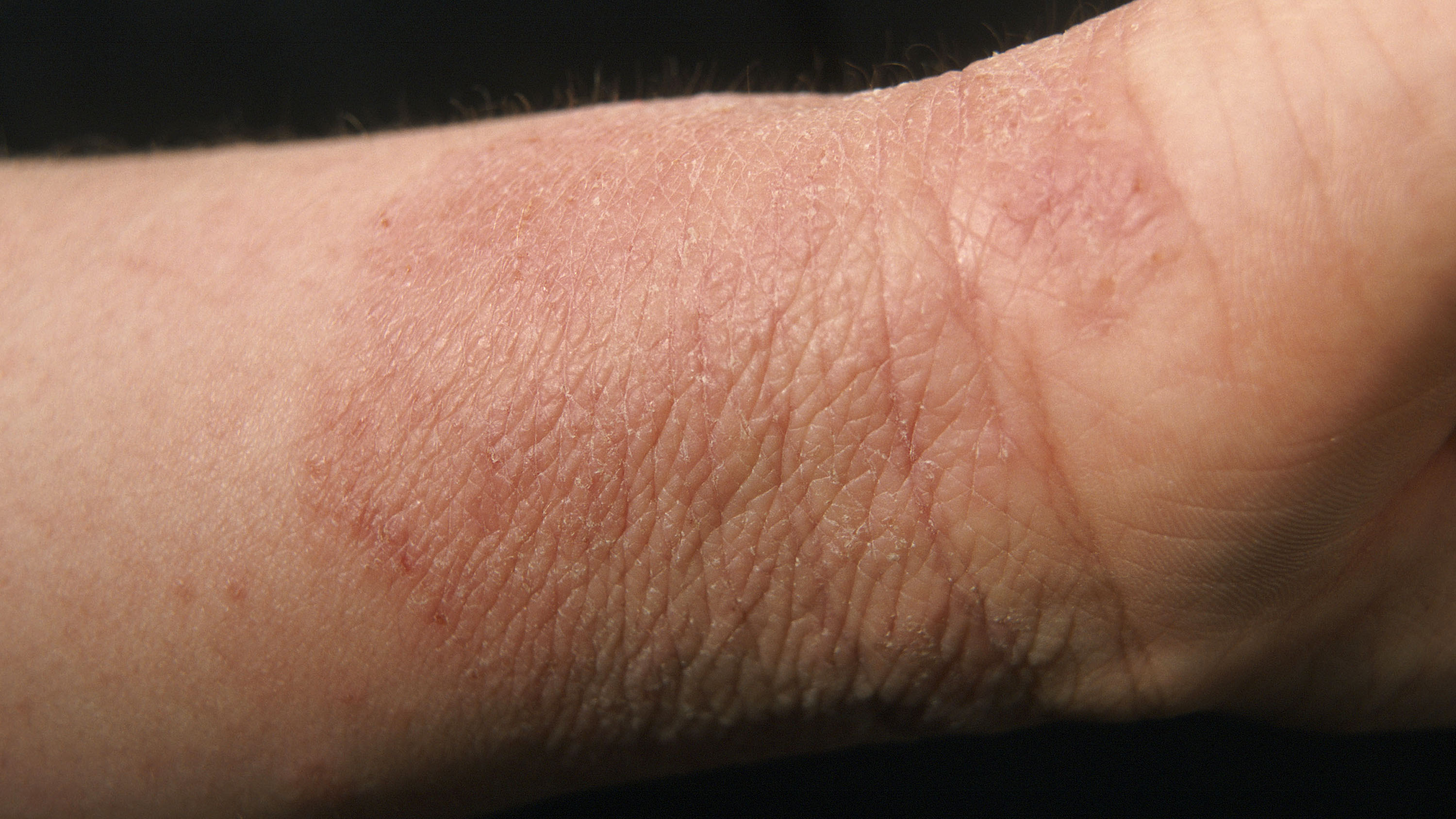 A Possible New Weapon Against Eczema Live Bacteria Cnn