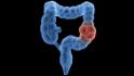 Get colon checked sooner, new guidelines say