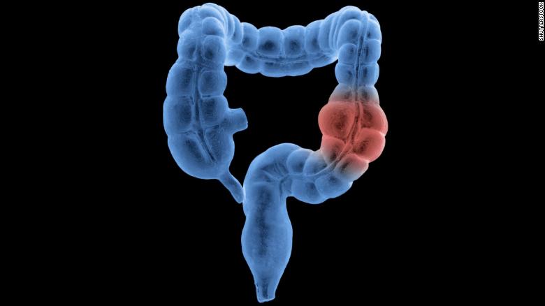 Get colon checked sooner, new guidelines say