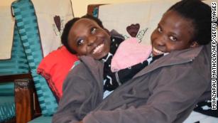 Tanzanian conjoined twins die at age 21