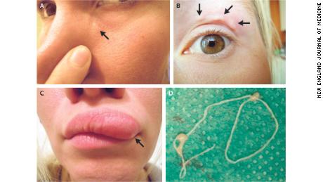 Woman&#39;s selfies capture moving lump on face: a parasite