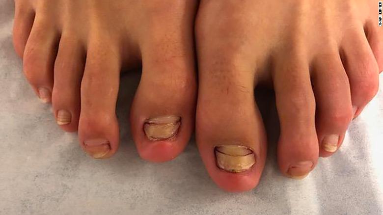 Six of the woman&#39;s toenails began to look abnormal in the months after a fish pedicure. This image appears in her case report.
