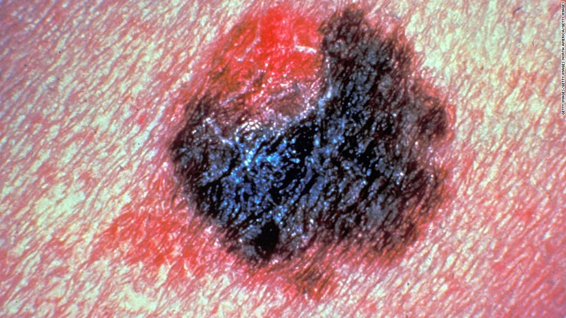 Experimental blood test could detect melanoma skin cancer early, study