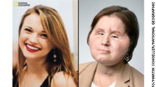 Historic face transplant gives suicide survivor a &#39;second chance&#39;