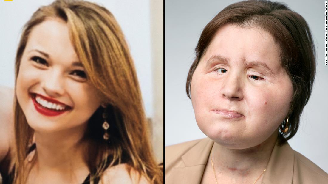 Katie Stubblefield Face transplant gives suicide survivor a second chance image image