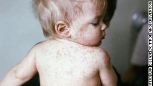 Measles outbreak in Israel prompts warning in New York