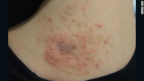 An example of contact dermatitis