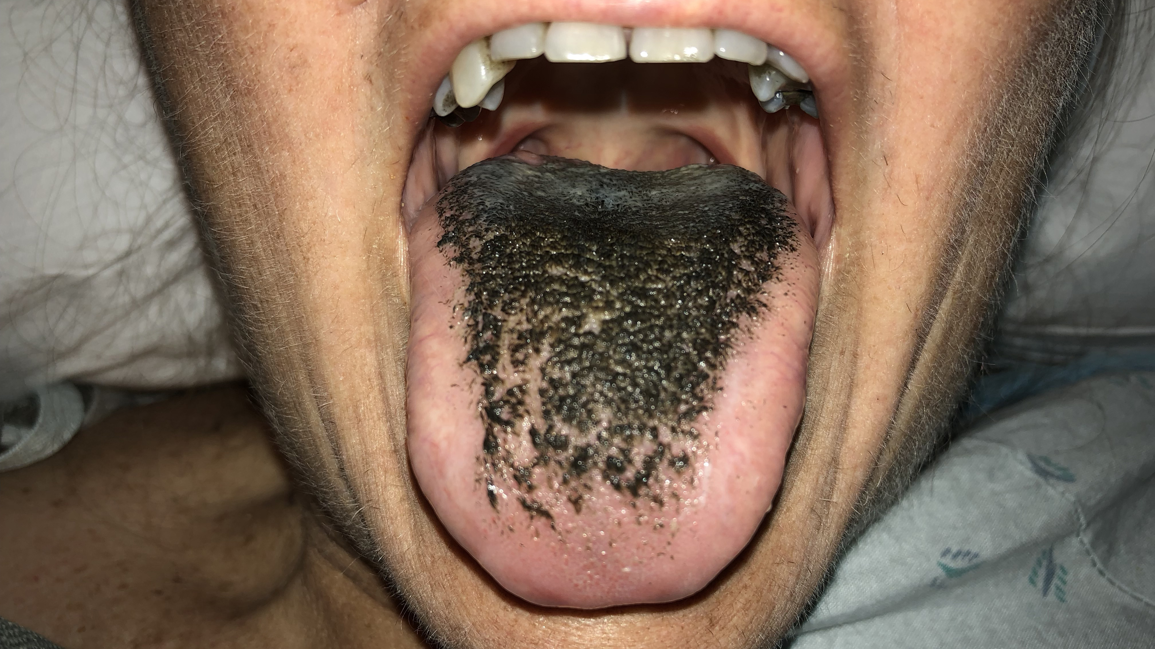 Black Hairy Tongue Here S What That Could Be Cnn