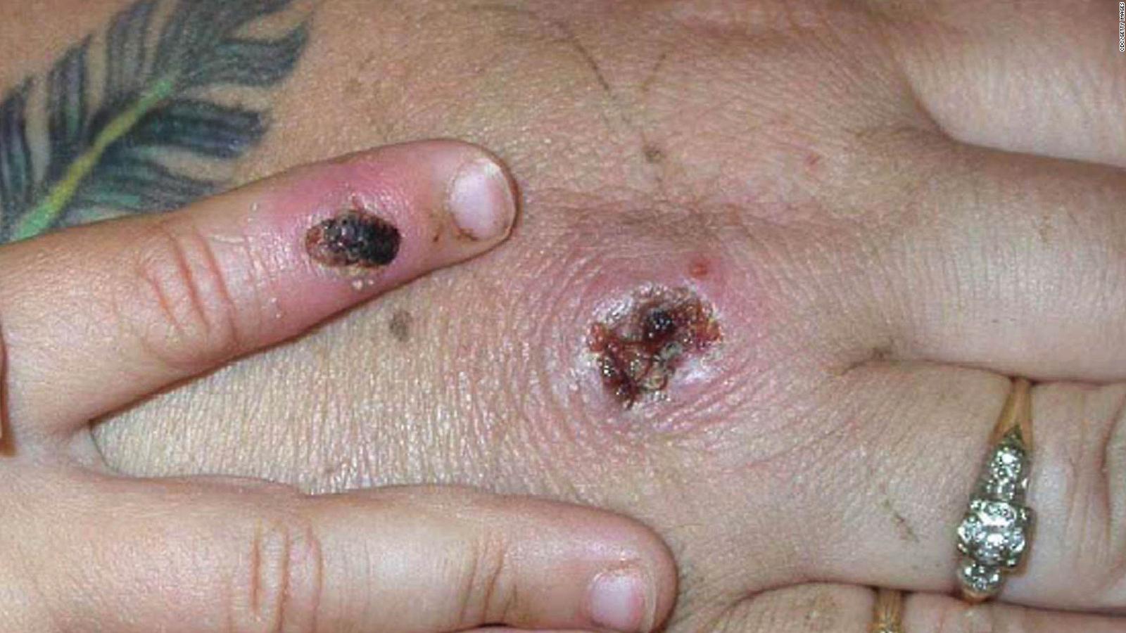 Monkeypox: First cases of rare infection diagnosed in UK - CNN