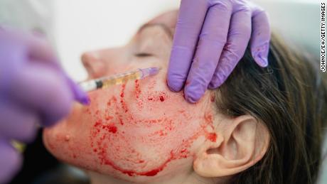 &#39;Vampire facial&#39; may have exposed spa clients to HIV, New Mexico health officials say