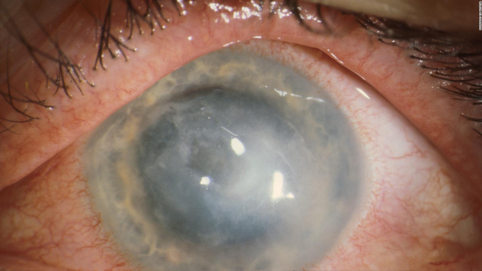 Outbreak Of Rare Eye Infection In Contact Lens Wearers Cnn 4363