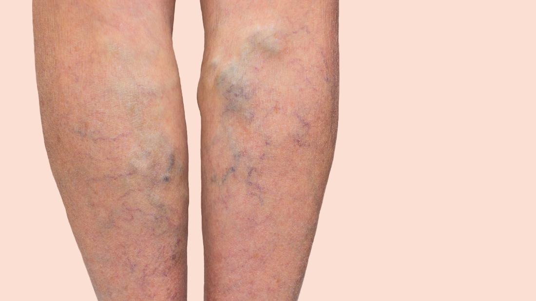 Varicose Veins May Be Genetically More Likely In Taller People Cnn 