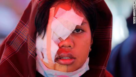 et victimapos;s ansigt bandages på et provisorisk hospital i Palu den 3.oktober.