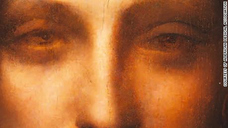 The painting &quot;Salvator Mundi,&quot; attributed to Leonardo da Vinci, shows his exotropia, a new study says.