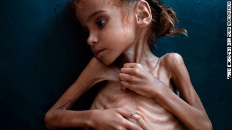 Starving girl who became symbol of Yemen crisis dies