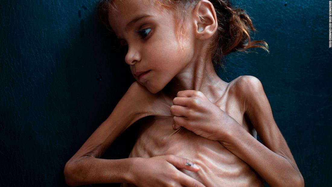 Image result for malnourished yemenis