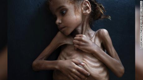 #NEWS:  Girl in iconic NYT image depicting Yemen famine dies ~ Yemen Health Ministry
Amal Hussein, a 7-year-old girl whose iconic image was captured by the New York Times has died, the Yemeni Health Ministry has confirmed. The stark photo of her emaciated body is one of the searing images of the Yemen&#39;s civil war.  A week after the image was published, and amid the international furor over the brutal killing of Saudi journalist Jamal Khashoggi in Saudi Arabia&#39;s consulate in Istanbul, US Secretary of Defense Jim Mattis and Secretary of State Mike Pompeo called on the participants in Yemen&#39;s 3-year civil war to agree to a ceasefire &quot;in the next 30 days&quot;.
~From journalist Hakim Almasmari in Sanaa.  Opening line by CNN&#39;s Dan Wright in London.
~Background from excellent digital write by Kevin Liptak, Elise Labott, and Zachary Cohen