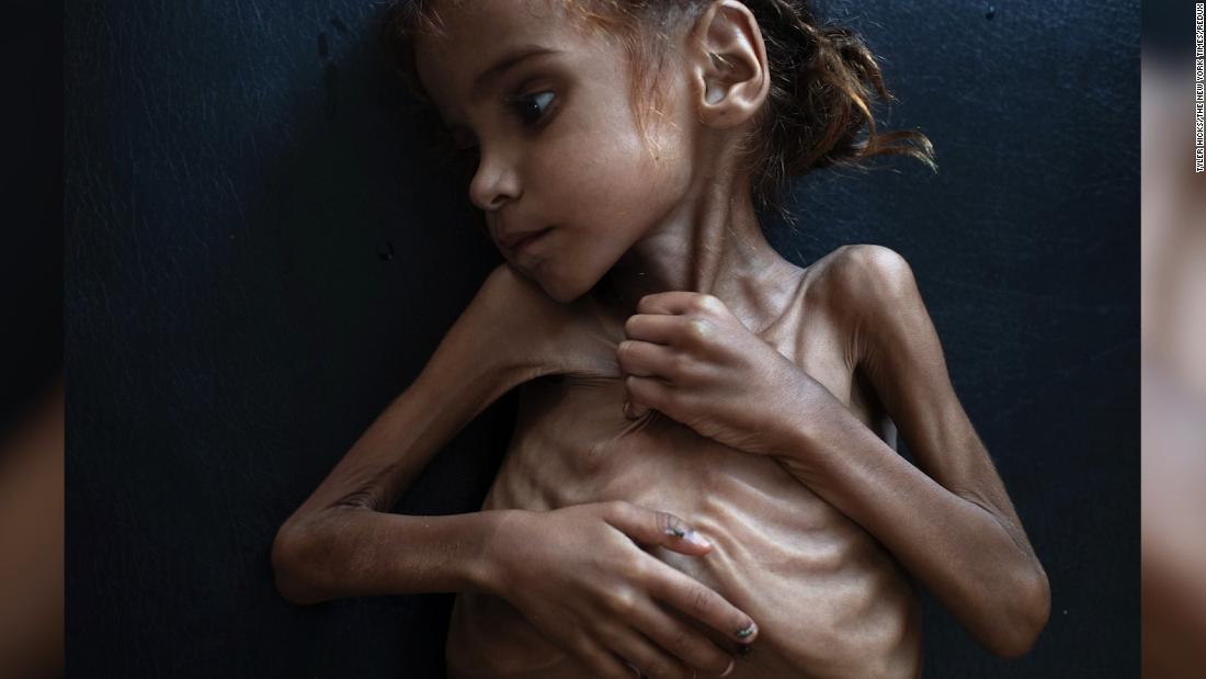 Muere Amal Hussein La Niña Que Simbolizó La Hambruna En Yemen Cnn Video 