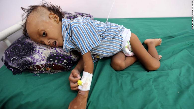 181120094407-02-hodeida-yemen-malnutrition-1117-exlarge-169.jpg