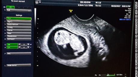 A sonogram shows the baby developing normally within the transplanted uterus.