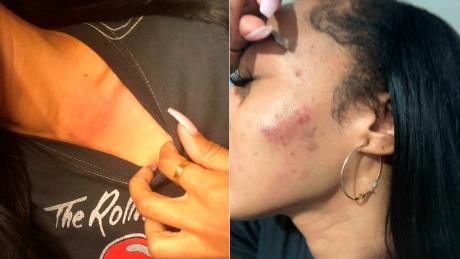 Attorney Adante Pointer releases photos of injuries allegedly sustained by his client Elissa Ennis during a domestic violence incident with former 49er Reuben Foster. 