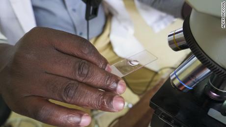 A lab technician at Kiruddu General Hospital examines a microscope slide for malaria.