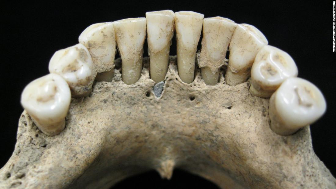 Although it&#39;s hard to spot, researchers found flecks of lapis lazuli pigment, called ultramarine, in the dental plaque on the lower jaw of a medieval woman.