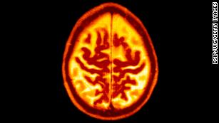 Regular aerobic exercise may slow progression to Alzheimer&#39;s for those most at risk