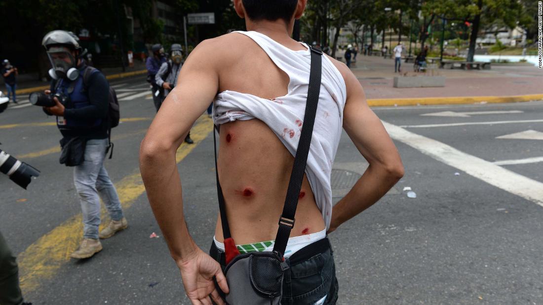A wounded protester shows his back as riot police clashed with opposition demonstrators in Caracas on January 23.