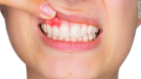 Gum infection could be linked to Alzheimer&#39;s, study says