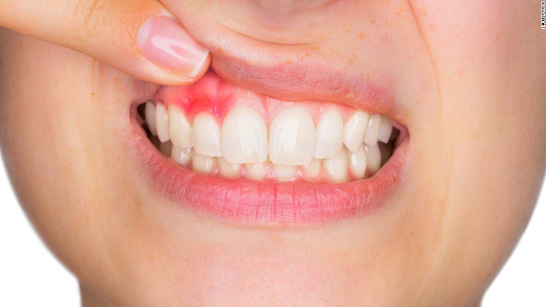 How To Tell Gum Infection