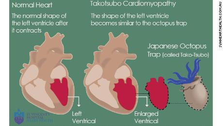 An illustration of takotsubo cardiomyopathy, also known as broken heart syndrome.