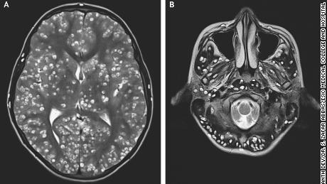 Damage-causing cysts were seen on MRI scans of the patient&#39;s cerebral cortex and brain stem.