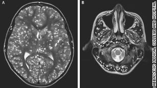 Teen dies of tapeworm larvae infestation in the brain