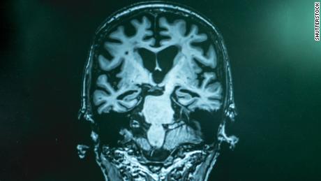 Alzheimer MRI