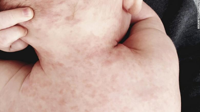 WHO: Measles cases up nearly 300% from last year