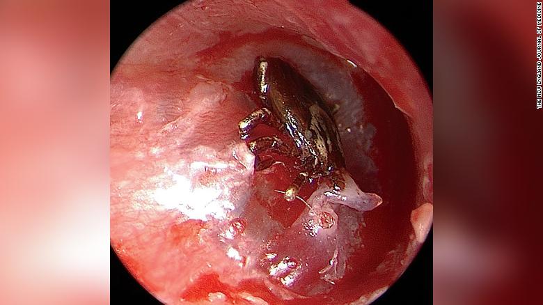 It was unusual, but a tick had embedded in a boy's right eardrum.