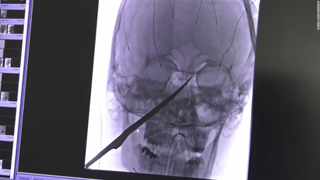 Teen Survives 10 Inch Knife Lodged In His Face It Could Have Been The